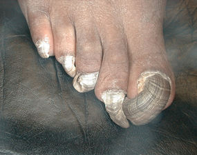 Bad Feet