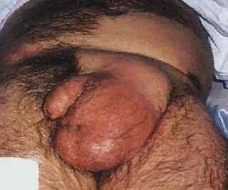 hernia