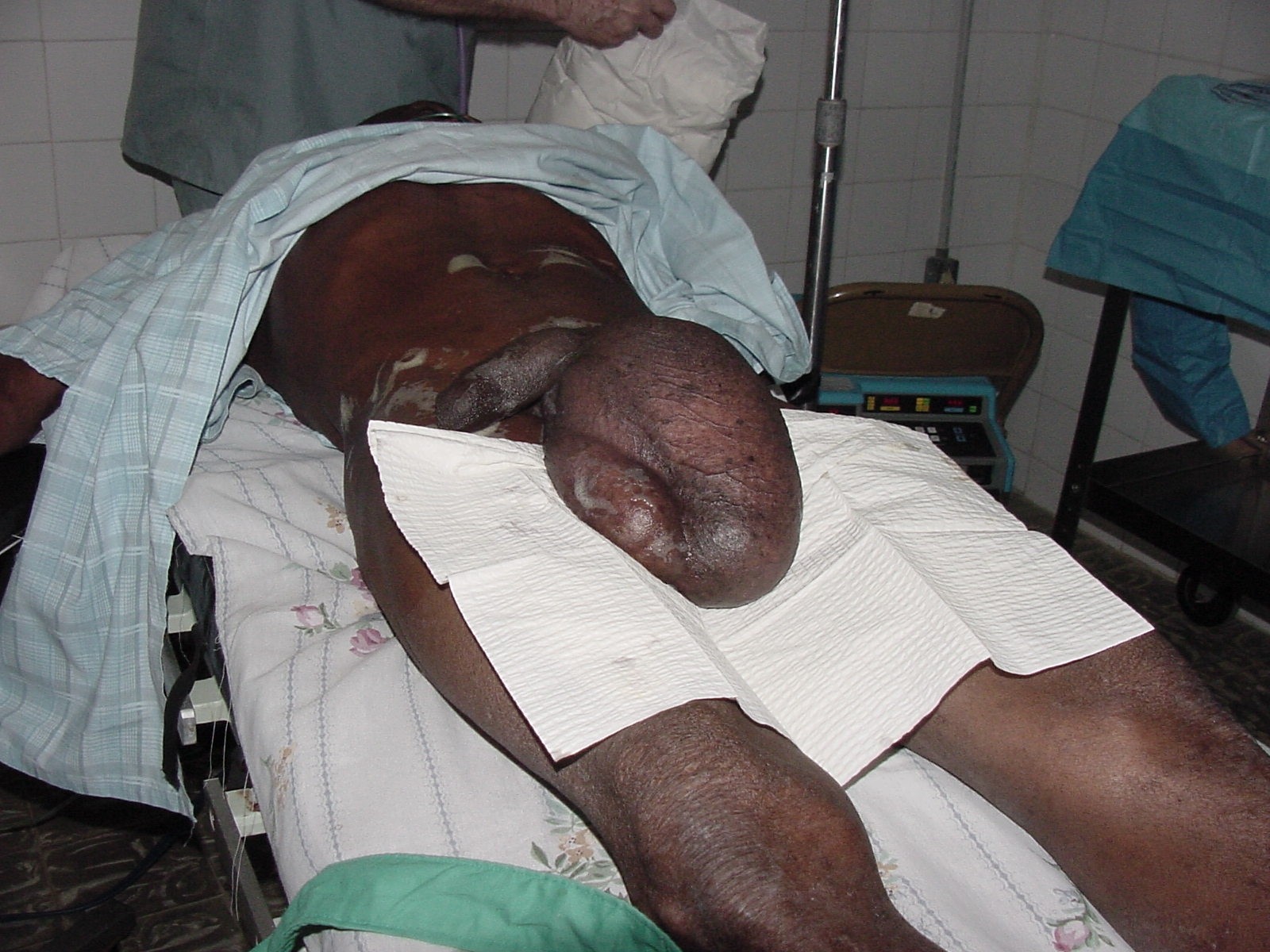hernia3